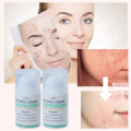 Crème pour les cicatrices d&#39;acné Pimple Dark Spot Remover