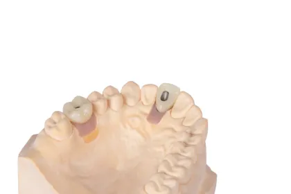 Anatomical Implant Restoration Crown