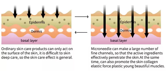 hyaluronic injection