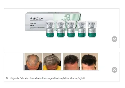 SCE+ HRLV EXOSOMES FOR HAIR RESTORATION