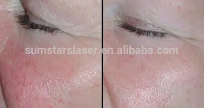 varicose veins laser treatment machine, laser veins skin treatment machine