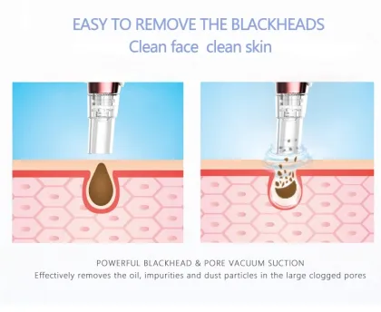 Blackhead Remover Tool