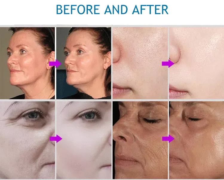 best at home radiofrequency device