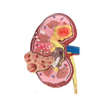 26.5x15x11cm Microstructure Human Diseased Kidney Anatomy Model: An Educational Tool for School Students