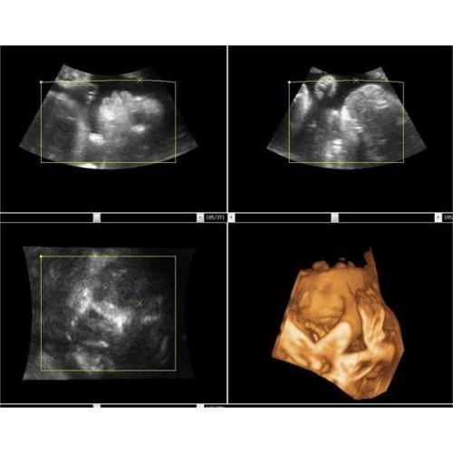 LCD -Ultraschall -Scanner für den medizinischen Gebrauch