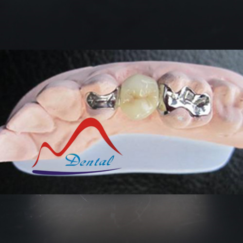 Pfm Maryland Bridge, Anterior And Posterior, High Quality Pfm Maryland