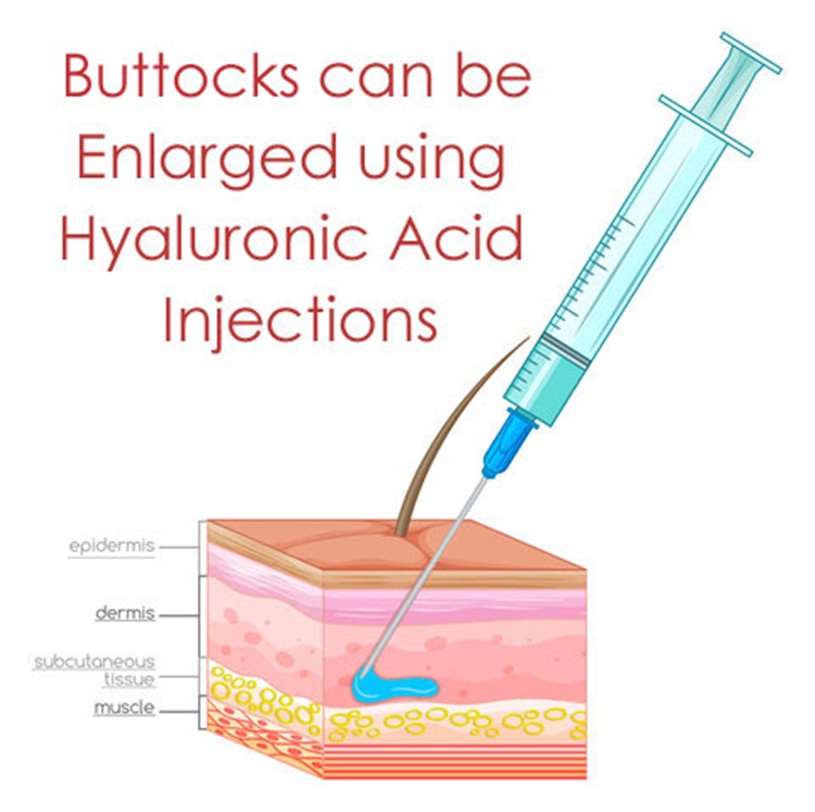 hyaluronic acid dermal filler injection