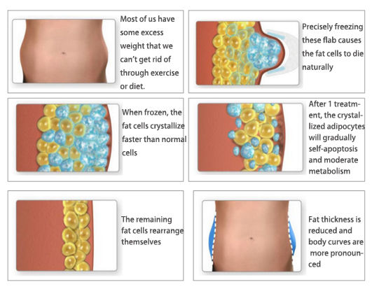 fat freeze machine