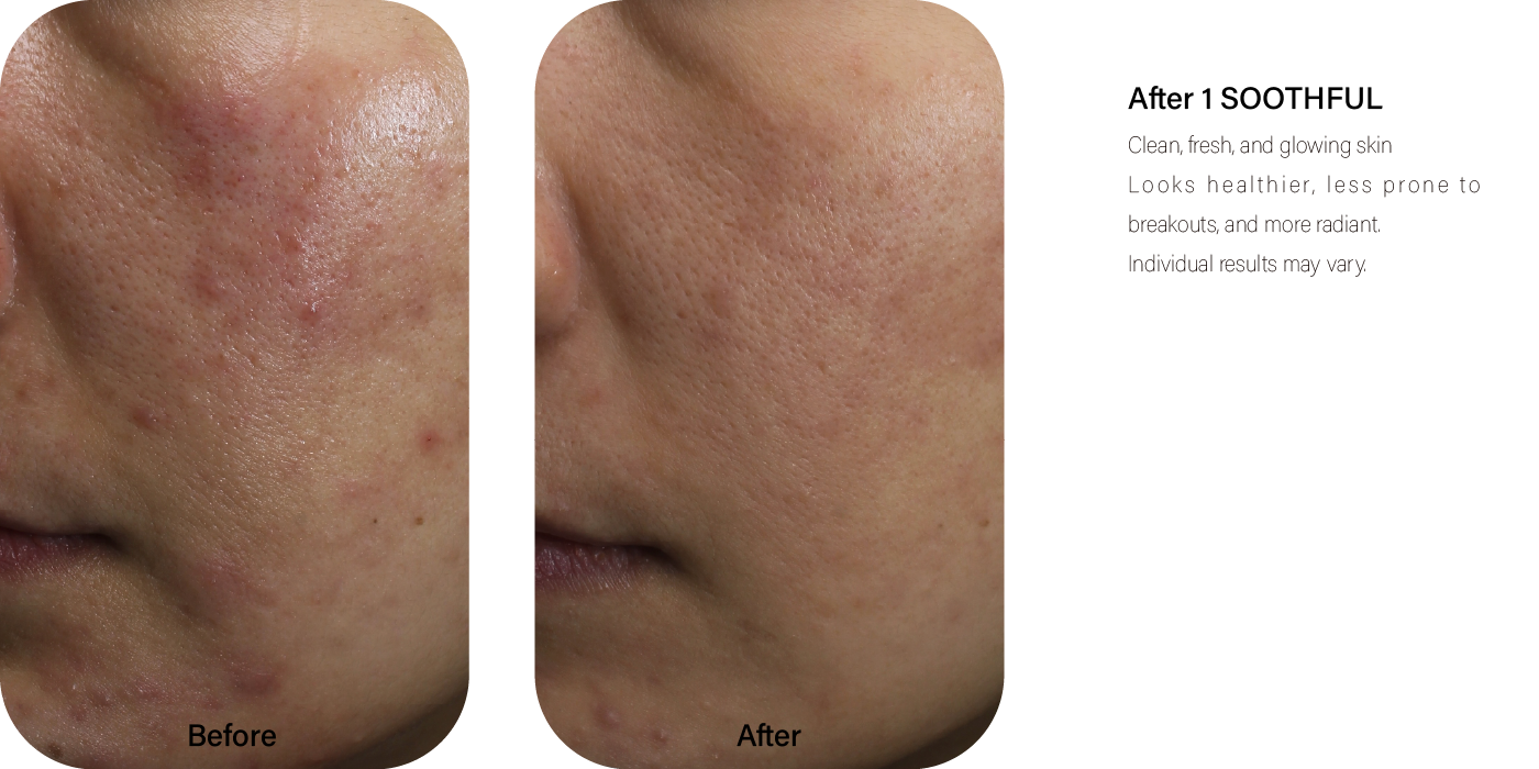 Sensitive Acne-Prone Skin