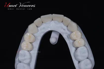 Strong zirconium oxide veneers