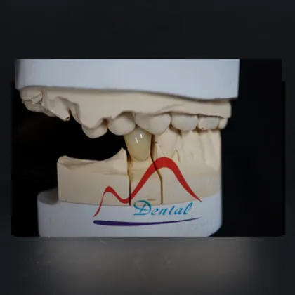 Totally bio compatible  Zirconia Crown