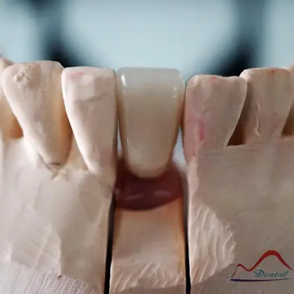 Mandibular Dental Implant Crown