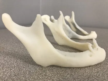 3D Printed medical implants