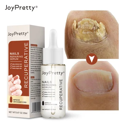 Foot Fungus Treatment: Antifungal Agents & Nail Care Solutions