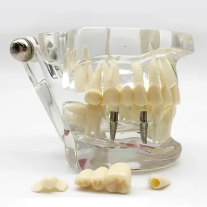 Orthodontic Dental Pathological Implant Teeth Model Study