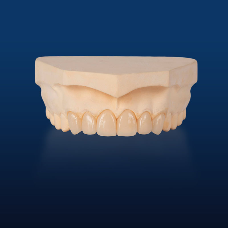 IPS Empress,Emax Onlay,Emax onlay,Emax Veneer,Lithium disilicate