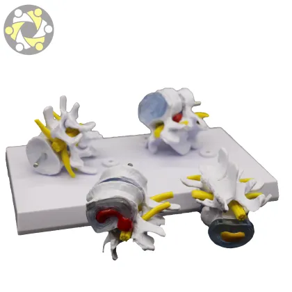 Pathological 4-Stage Human Lumbar Vertebrae Spine Disease Model