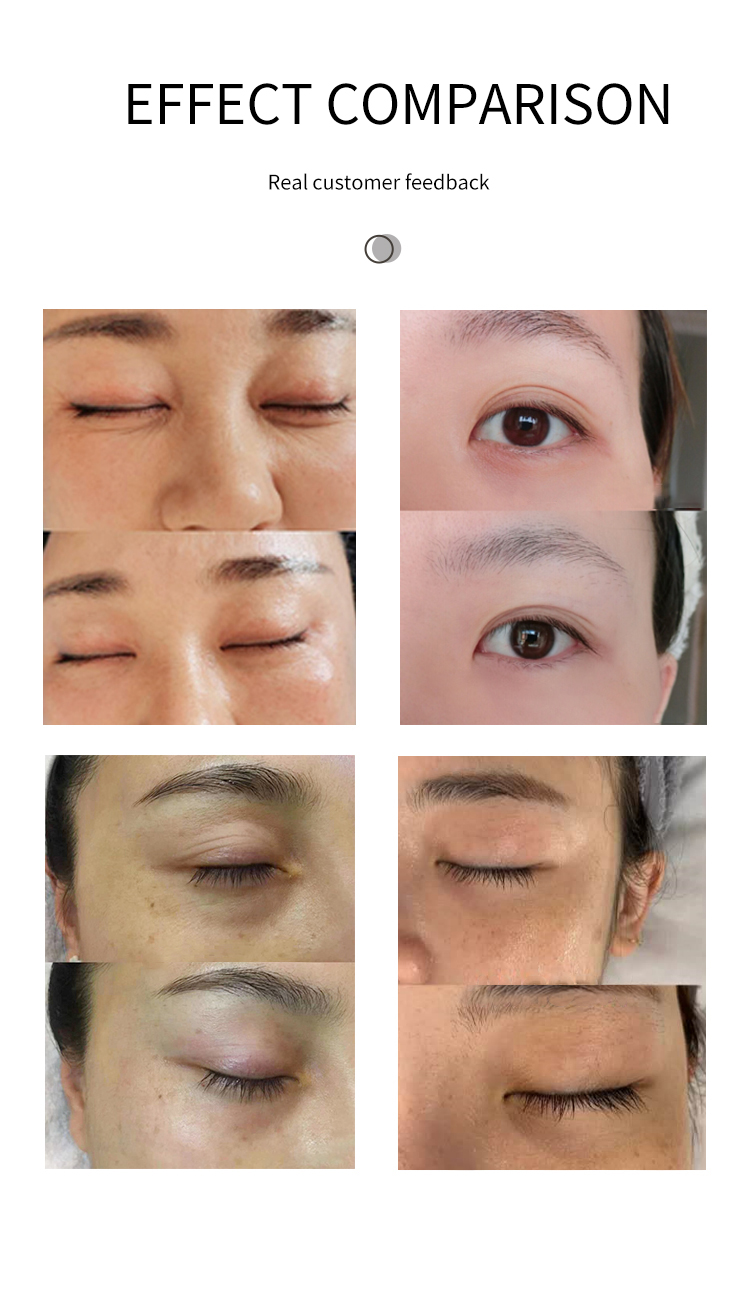 skin tightening