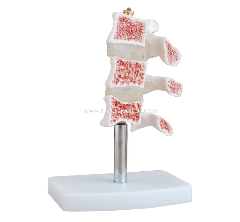 Cutaway Osteoporosis Model for Medical Teaching