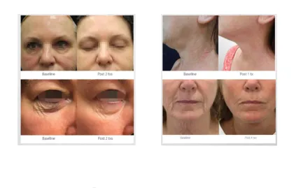 Freckle Removal Pen: Beauty Salon Machine for Laser and Plasma Freckle Removal