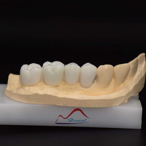 Posterior Aestherics Diagnostic Wax Up