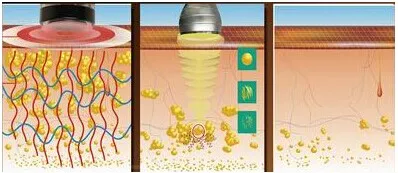 thermage rf beauty machine&thermage rf face lifting machine