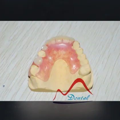 Mega Valplast Flexible Denture