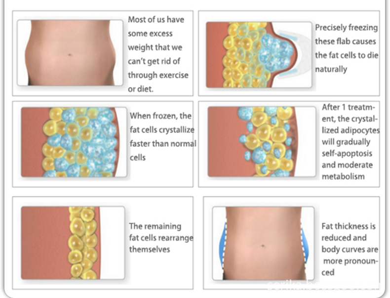 Cryo Lipo Machine