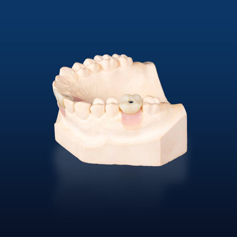 Dental Implant Crown, Dental Implant Zirconia crown,Dental Implant Emax crown,Dental Implant Bridge