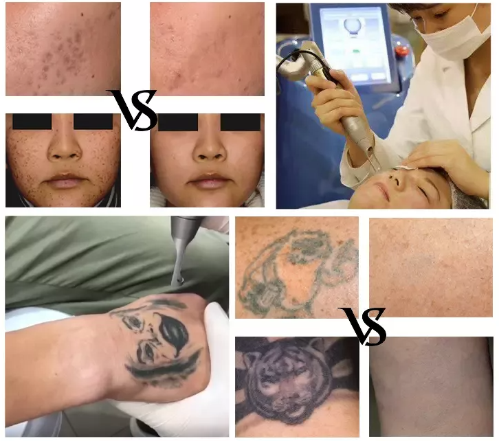 Máquina de remoção de tatuagem a laser de laser q