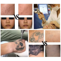 Máquina de remoção de tatuagem a laser de laser q