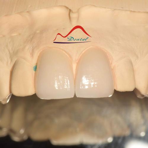 Dental Aesthetic Porcelain Veneers
