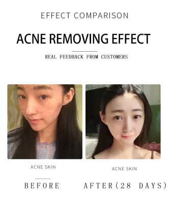 Portable Blackheads Acne Patch Treatment Tester for Beauty Salon