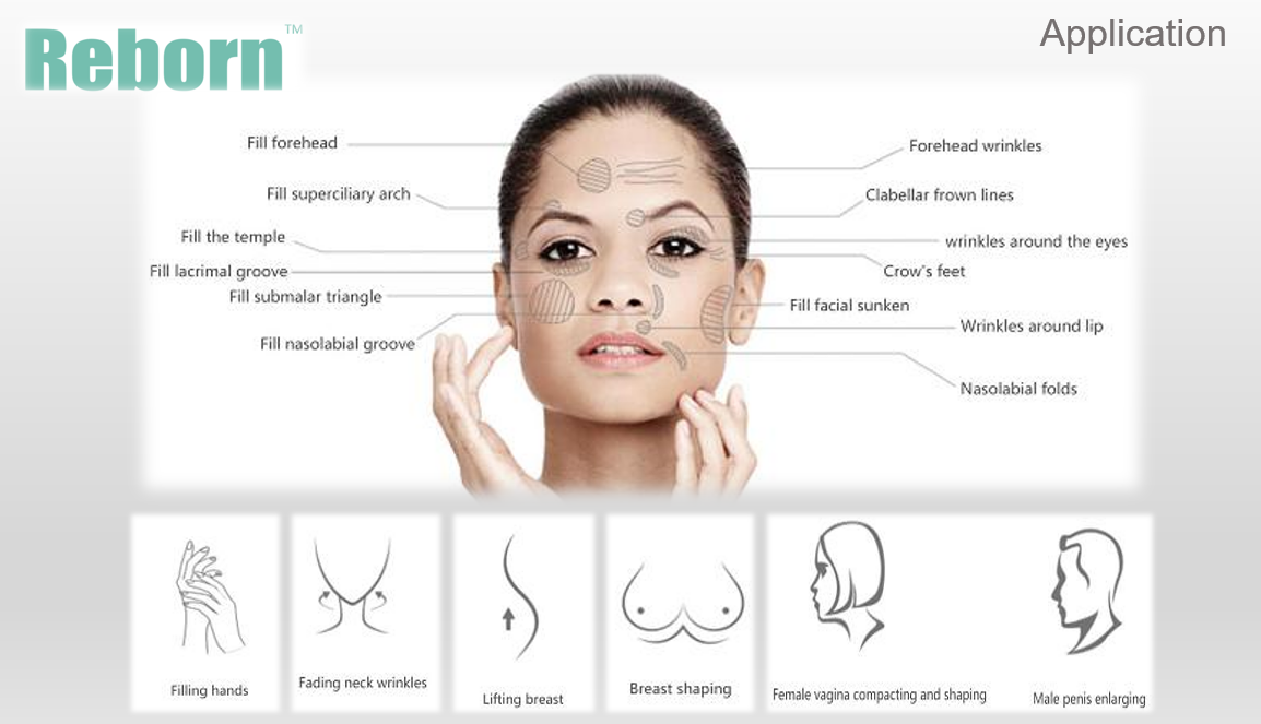 dermalfillers