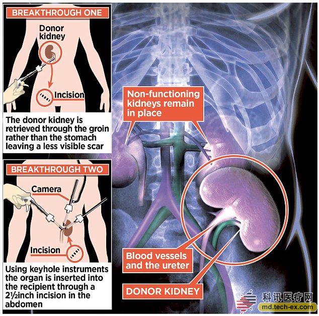 Disposable Laparoscopic Trocar 