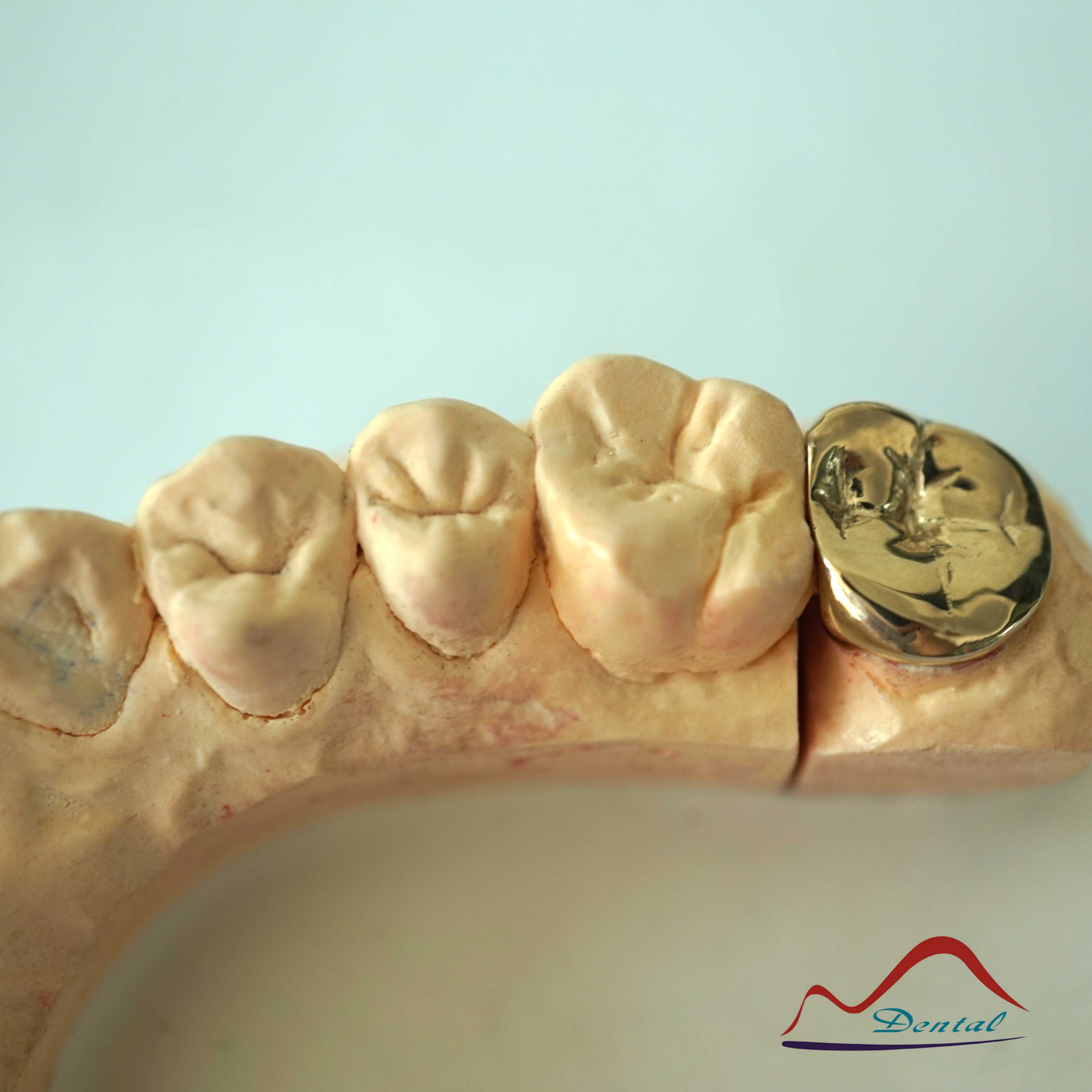 DENTAL Molar Gold Onlay b