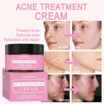 pimple cream for men acne cream