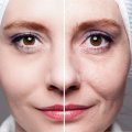 Dermal Fillers for Under Eyes