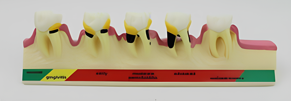 Modelo de enfermedad periodontal (enfermedad periodontal)