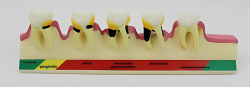 Modelo de doença periodontal (doença periodontal)