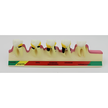 Model penyakit periodontal (penyakit periodontal)