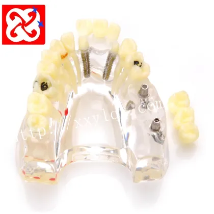 Dental Model Upper Half: Implant and Restoration
