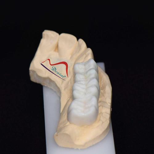 Posterior Aestherics Diagnostic Wax Up
