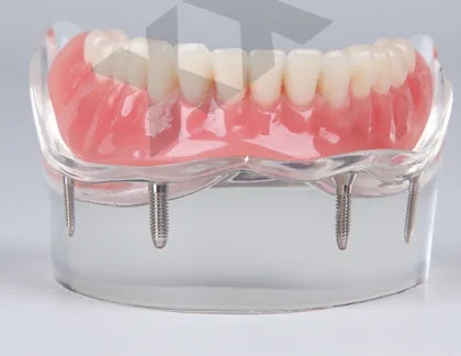 Mandibular Overdenture Implant Teeth Model with 4 Implants