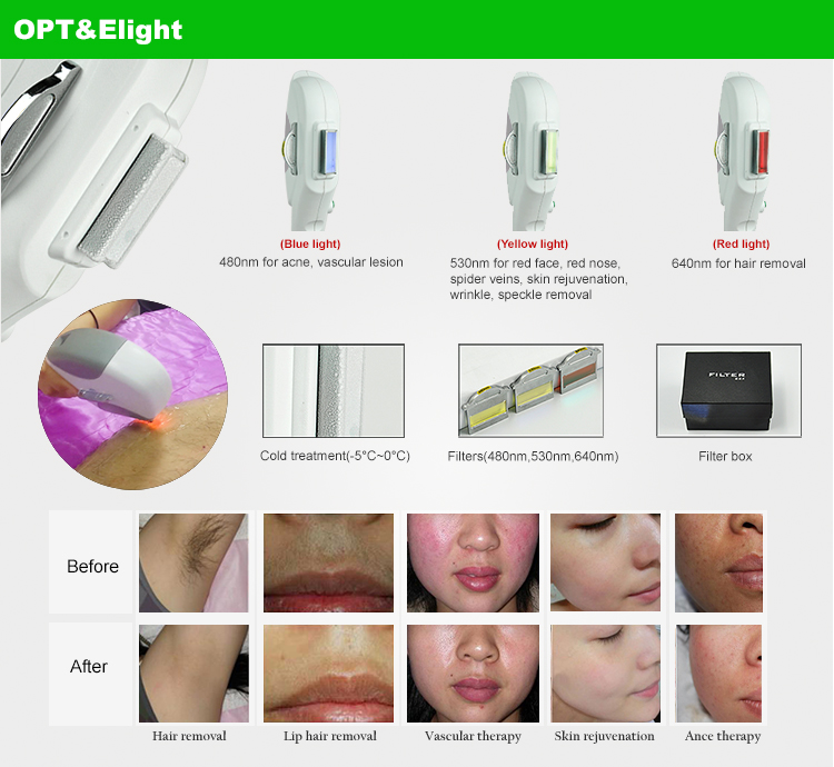 laser hair removal handset