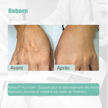 Mesotherapy Products Injection PLLA Hydrogel Filler