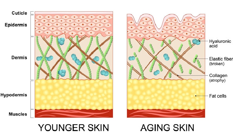 hyaluronic acid filler