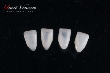 Langlebiges Whitening -Furnier für Zähne