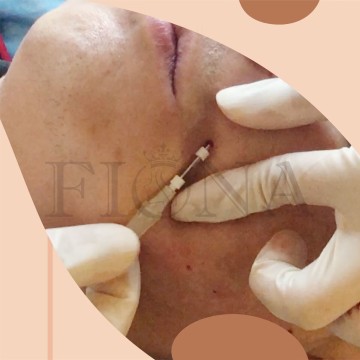 2024 Factory Fiona: 19G38MM/60MM PCL Filler Mesh Threads for Long-Lasting Wrinkle Reduction - Up to 18-24 Months Effect