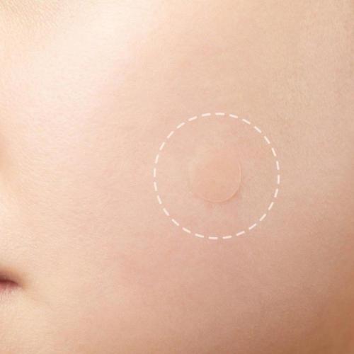 7,5*7,5 cm potente acne patch idrocolloide